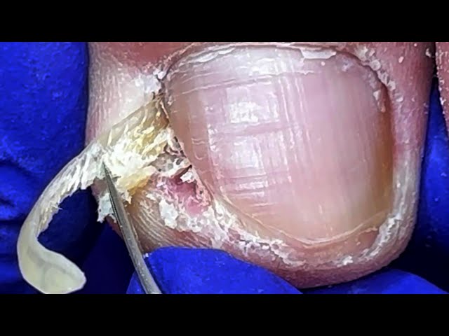 The big hook is embedded in the root of the nail, dig it out carefully【Doctor Liu Pedicure】