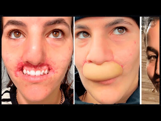 Remember the model who had her lip ripped off by a dog? She is beautiful