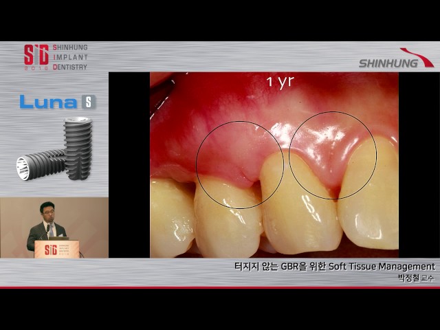 JCPARKLAND 박정철 교수 LECTURE 5 - 터지지 않는 GBR을 위한 Soft Tissue Management / SID 2016