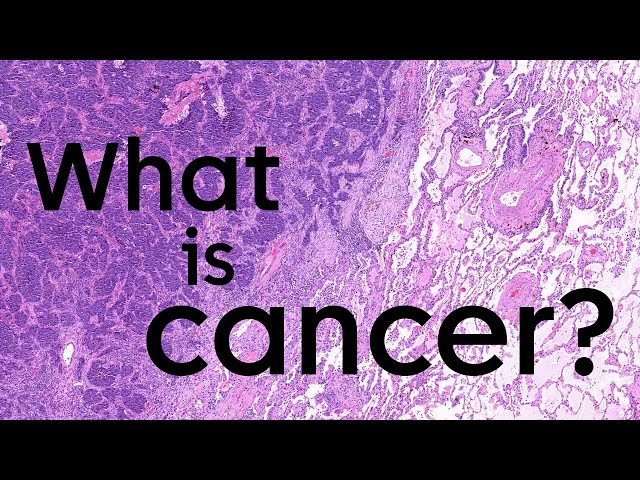 What is cancer and how does it start? | Cancer Research UK