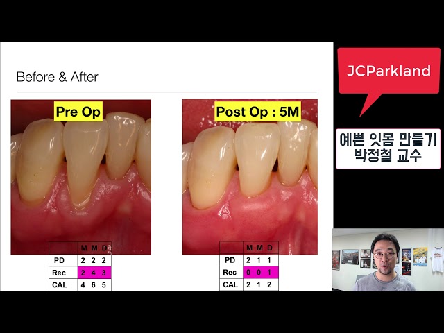 [일반인을 위한 치주강의] 6-3 예쁜 잇몸 만들기 - 잇몸 성형 수술 - JCParkland 박정철 교수