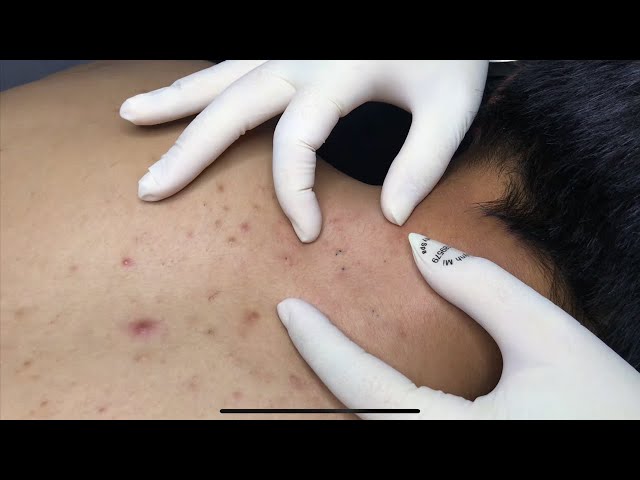 ACNE TREATMENT WITH VU QUYNH MI | Acne on Back & Chest 2023(p1)