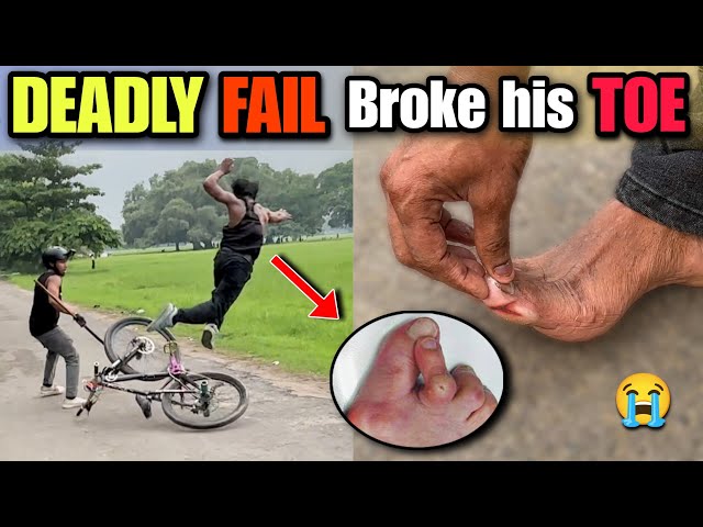 EPIC CRASH ALERT🚨 | Cycle Stunt Results in Broken Toe!