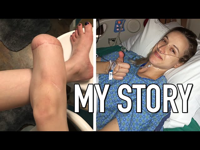 Walking into a hospital & leaving as an amputee: my amputation story   [CC]