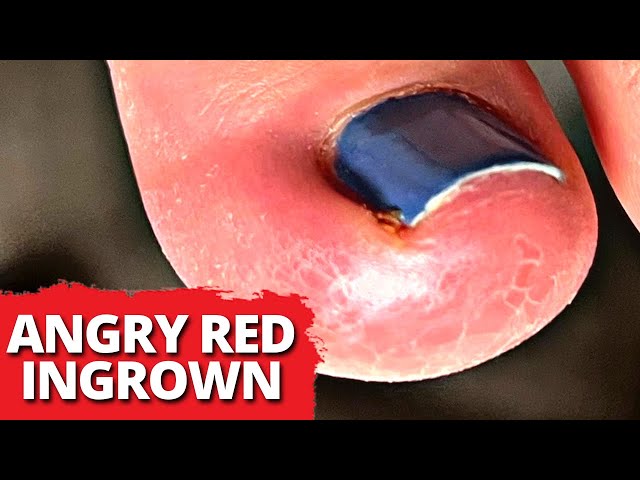 DEEP Red Ingrown Nail Removal