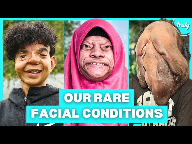 9 Of The Rarest Facial Conditions In The World | BORN DIFFERENT