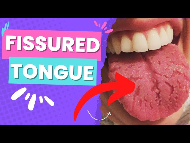 FISSURED TONGUE - WHAT IS IT - WHAT CAUSES IT? HOW TO MANAGE IT!